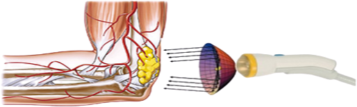 Infographic How Softwave Therapy Works | Wave of Health